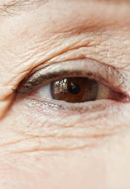 Blefaroplastia